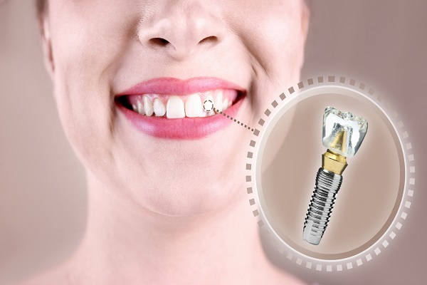 How Easy Is It To Replace An Implant Crown?